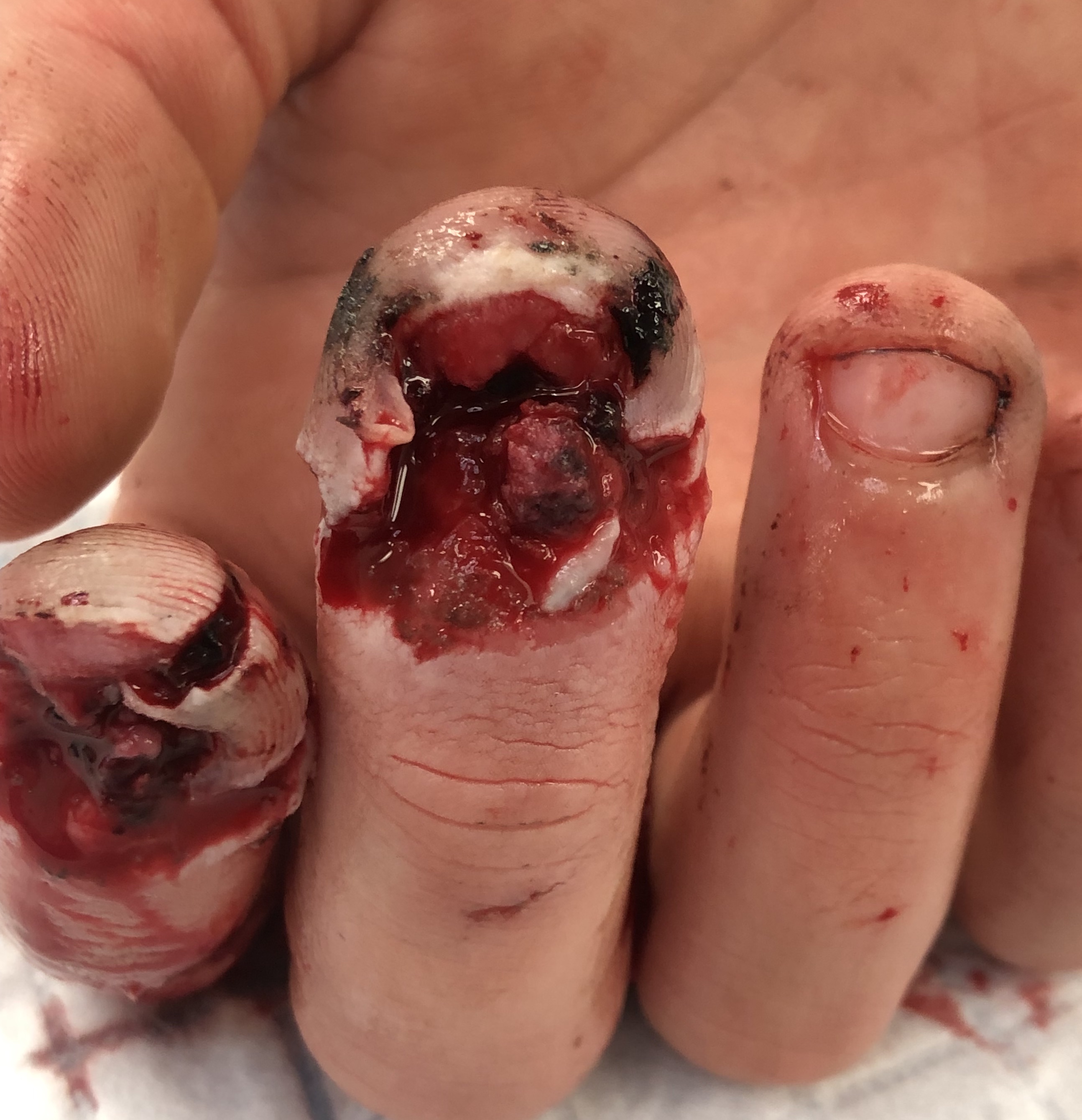 Complete nail bed injury